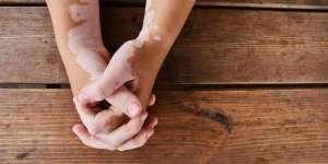 Menguak Fakta Vitiligo, Kerap Diklaim Sebagai Penyakit Kutukan