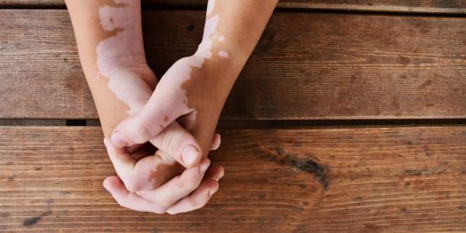 Menguak Fakta Vitiligo, Kerap Diklaim Sebagai Penyakit Kutukan