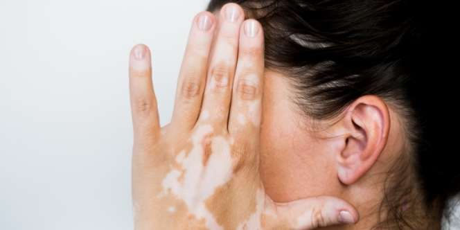 Pasien Vitiligo Kerap Alami Masalah Psikis