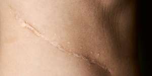 3 Penyebab Luka Pasca Operasi Terasa Sangat Gatal