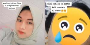 Wanita Ini Alami Infeksi Akibat Kebiasaan Mengelupas Kulit Bibir