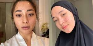 7 Seleb Cantik Pejuang Jerawat, Ada yang Sampai Parah Banget!
