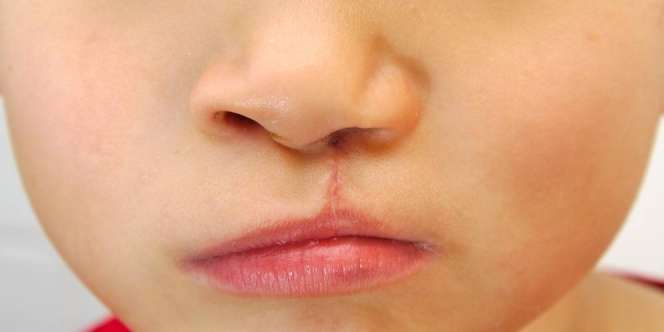 Paparan Pestisida dan Timbal Tingkatkan Risiko Bibir Sumbing