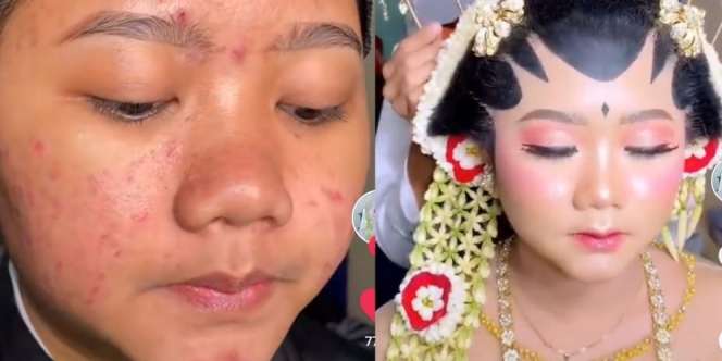 Transformasi Wajah Pengantin Berjerawat, Hasilnya Bikin Pangling
