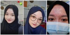 Tertarik Iklan Masker Wajah, Muka Cewek 'Hancur', Dulunya Mulus dan Glowing