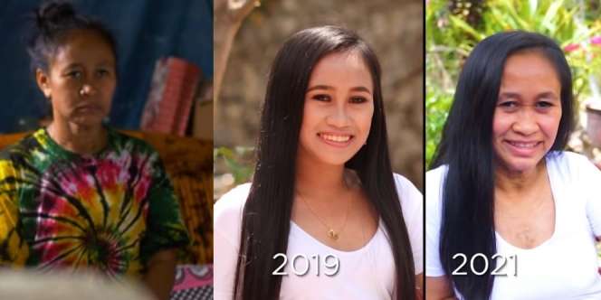 Idap Penyakit Langka, Wajah Gadis 16 Tahun Ini Berubah Seperti Wanita Usia 50 atau 60 Tahunan