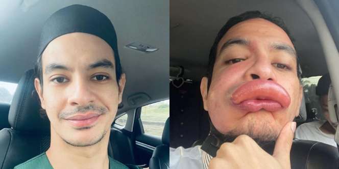 'Guys Ini Bukan Filter', Bibir Aktor Terkenal Ini Jontor Beneran Usai Cuci Muka Subuh-Subuh