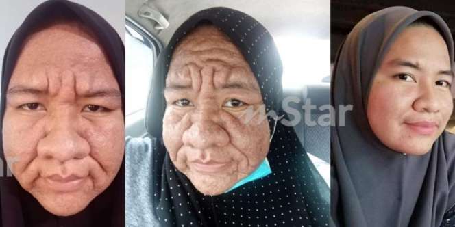 Wanita Hamil Alami Kondisi Aneh, Wajah Bengkak dan Keriput Mirip Nenek-Nenek