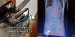 Geger! Bocah Laki-Laki Telan 6 Baterai, Ibunya Nyaris Pingsan Lihat Hasil X-Ray