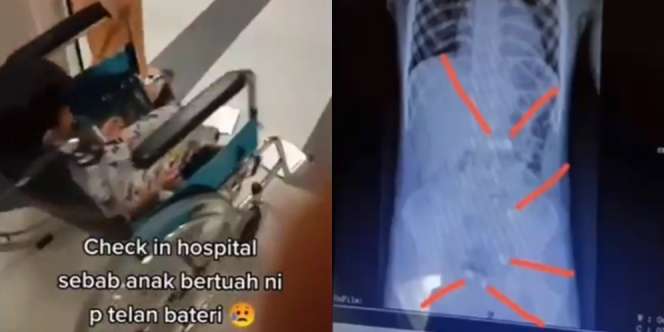Geger! Bocah Laki-Laki Telan 6 Baterai, Ibunya Nyaris Pingsan Lihat Hasil X-Ray