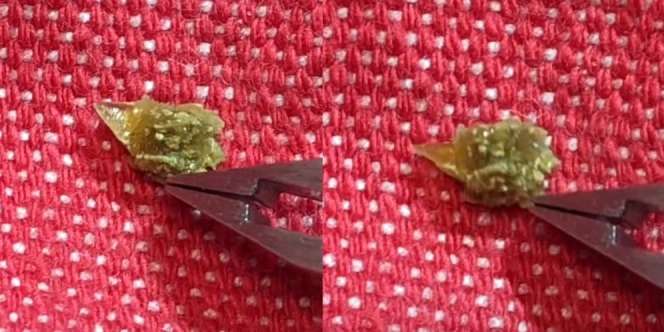 Bikin Ngilu, Begini Penampakan Kristal Berduri yang Keluar Saat Penderita Batu Ginjal Buang Air Kecil
