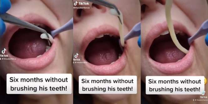 Akibat Tidak Gosok Gigi Enam Bulan Keluar Benda Mirip Cacing dari Mulut, Cek Faktanya!