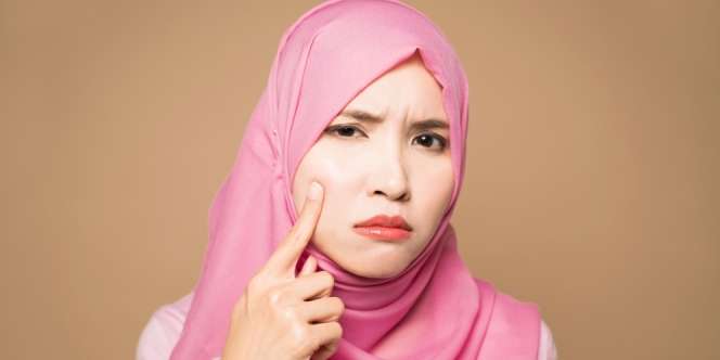 Apakah Memakai Bahan Alami Lebih Baik untuk Mengatasi Jerawat?