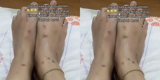 Baru Pindah Kos Kaki Wanita Langsung Dipenuhi Bentol, Kasurnya Bikin Merinding!