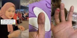 Gadis Derita Penyakit Aneh, Jari Keriput dan Mudah Terkelupas: Nikmat Makan Pakai Tangan Pun Hilang