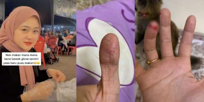 Gadis Derita Penyakit Aneh, Jari Keriput dan Mudah Terkelupas: Nikmat Makan Pakai Tangan Pun Hilang