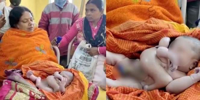 Bayi di India Lahir dengan 4 Tangan dan 4 Kaki, Warga Percaya Sebagai Titisan Dewa