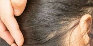 9 Mimpi Banyak Kutu Rambut Menurut Primbon Jawa, Tanda Rejeki yang Tak Terduga