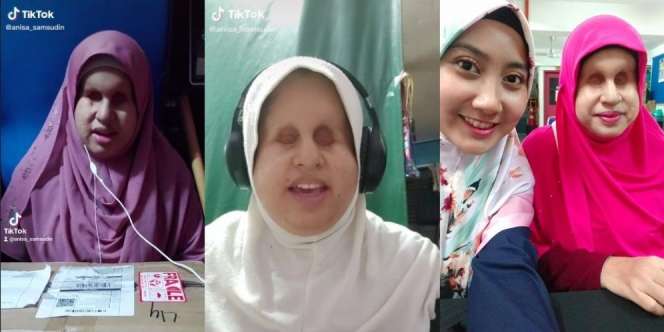 Kisah Wanita Seumur Hidup Dipandang Rendah karena Matanya, Berani Jualan di TikTok dan Kini Hidupnya Berubah