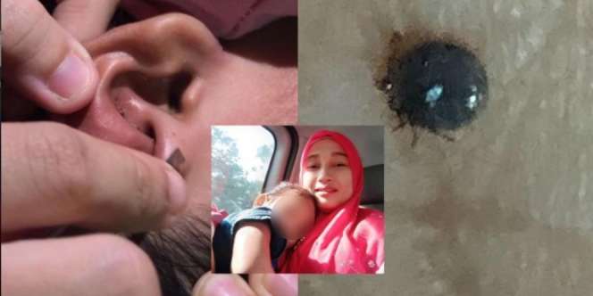 Anak Meraung Sambil Pegangi Dua Telinga, Pas Dicek Ada 2 Butiran Hitam Sebesar Beras Nempel Kuat di Kulit