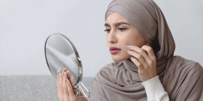 Begini Cara Pakai Obat Jerawat Agar Pemakaiannya Efektif, Tak Cuma Dioles!