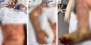 Keracunan Bakteri Usai Santap Mie Ayam Sisa Teman, Mahasiswa Harus Amputasi Jari dan Kaki