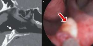 Sulit Nafas Tidak Sembuh-Sembuh, Pas Periksa Kaget Ada Gigi Tumbuh dalam Hidung