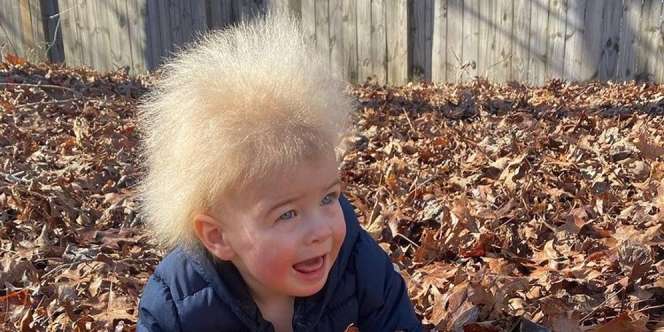 Bocah Lucu Kena Sindrom Langka, Rambutnya Selalu Jabrik
