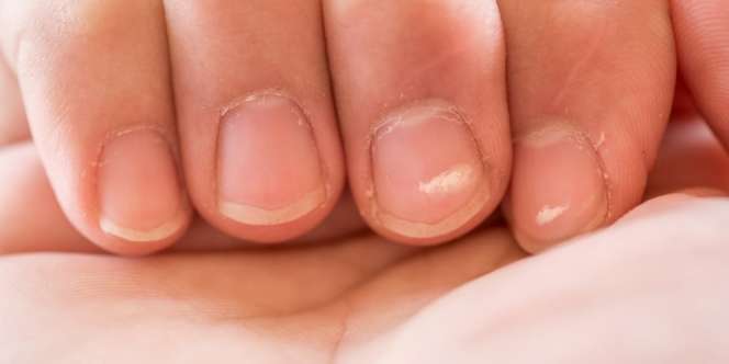 Biasa Diartikan Tanda Kangen, Ini Penyebab Bintik Putih di Kuku