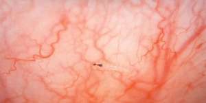 Pria Ini Merasa Gatal Tak Tertahan di Mata Kanan, Saat Diperiksa Dokter Ternyata Jadi Tempat Hidup Belasan Belatung