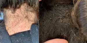Bikin Bergidik! Penata Rambut Butuh 9 Jam Buat Hilangkan Kutu Rambut di Kepala Gadis Ini
