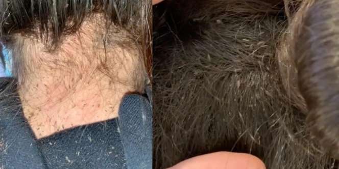 Bikin Bergidik! Penata Rambut Butuh 9 Jam Buat Hilangkan Kutu Rambut di Kepala Gadis Ini