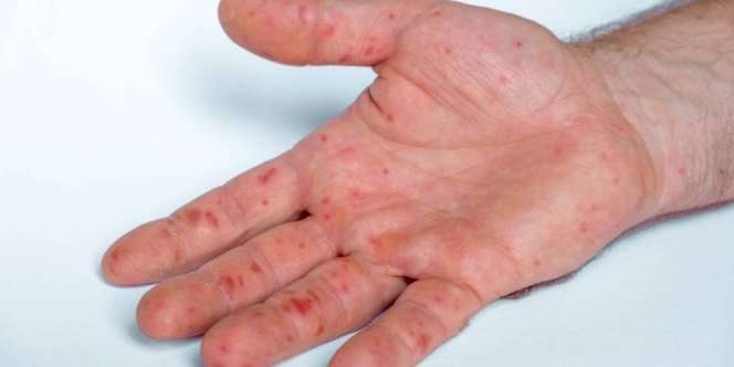 Fakta Soal Penularan Cacar Monyet, Wajib Waspada