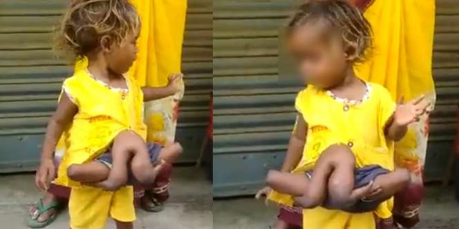Gadis 'Laba-laba' Ini Lahir dengan 4 Tangan dan 4 Kaki, Pernah Ditawar Kelompok Sirkus