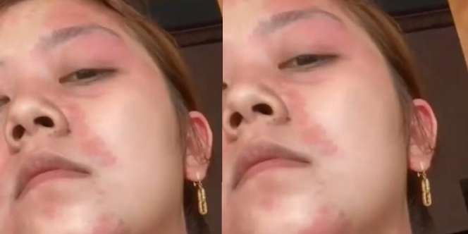 Suntik Putih Selama 2,5 Tahun, Kulit TikToker Rusak hingga Alami Gejala Autoimun