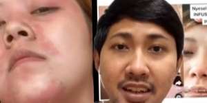 Benarkah Gejala Autoimun Muncul Akibat Suntik Putih? Dengar Penjelasan Dokter