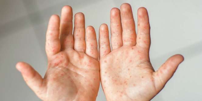 Mirip Cacar, Dokter Anak Ingatkan Keluhan Khas Flu Singapur