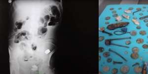Mengeluh Sakit Perut, Dokter Syok Temukan Koin, Baterai, Kuku, sampai Baut di Tubuh Pasien