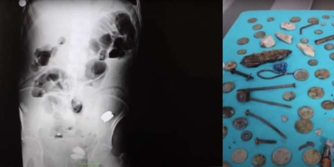 Mengeluh Sakit Perut, Dokter Syok Temukan Koin, Baterai, Kuku, sampai Baut di Tubuh Pasien