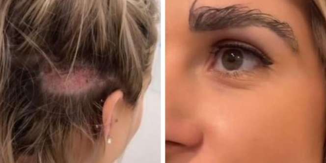 Lakukan Transplantasi Alis dari Rambut Kepala, Alis Wanita Ini Terus Panjang Tak Berhenti Tumbuh