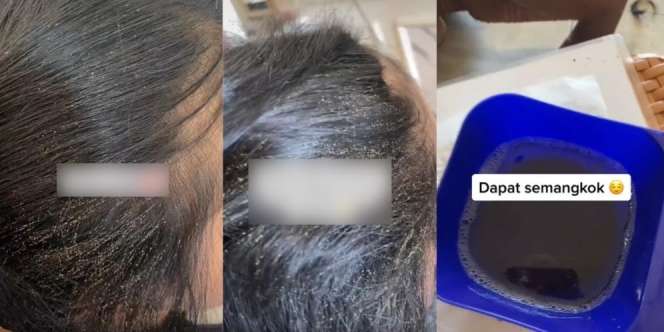Pemilik Salon Syok Lihat Kutu Rambut Menempel Kayak Butiran Beras, Cuma Disisir Dikit Langsung Dapat Semangkok