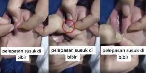 Bikin Ngeri dan Ngilu, Ternyata Begini Proses Pelepasan Susuk Bibir