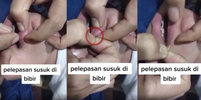 Bikin Ngeri dan Ngilu, Ternyata Begini Proses Pelepasan Susuk Bibir