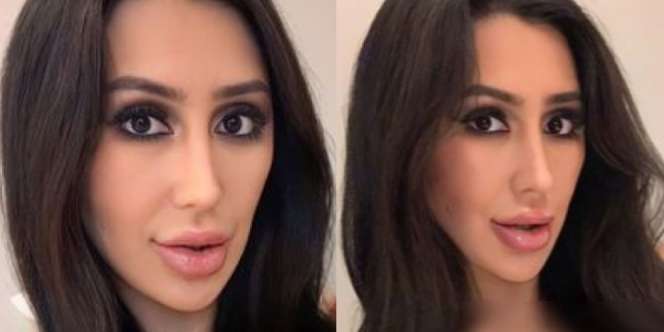 Guru di Korsel Habiskan Uang Orang Tua Rp890 juta Demi Mirip Kim Kardashian 