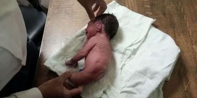 Kasihan, Bayi Lahir Cacat Tanpa Kaki, Digantikan Tulang Besar Mirip Tanduk