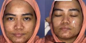 Transformasi Makeup Barbie Look Cewek Berjerawat Ini Hasilnya Bikin Melongo!