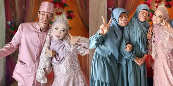 8 Potret Surya Manurung `Pengidap Sindrom Langka` Usai Nikahi Wanita Cantik, Kemesraannya Disorot!