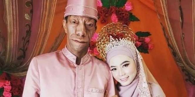 5 Potret Cantiknya Shasa Puspita Dewi, Istri Surya Manurung Pria Pengidap Sindrom Langka