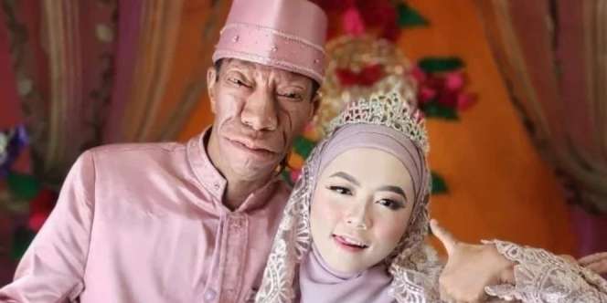 Begini Awal Perkenalan Surya Manurung Pria Pengidap Sindrom Langka dengan Istrinya