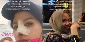 Potret Wanita yang Lakukan Oplas karena Insecure, Transformasinya Bikin Melongo!